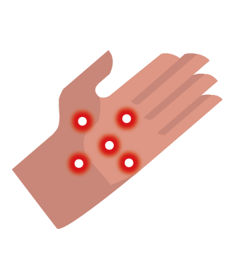 Monkeypox-07